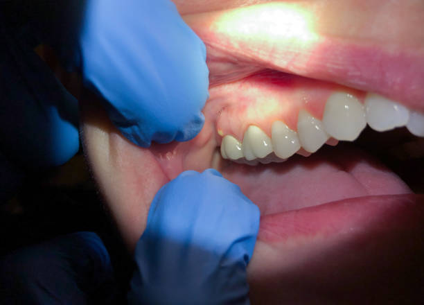 Best Urgent Care for Lost Fillings or Crowns in Kinnelon, NJ